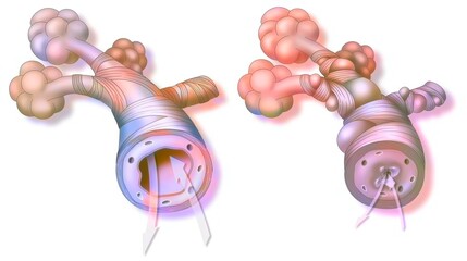 Asthma: healthy bronchiole (left) and asthmatic (right).