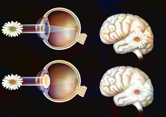 Comparison between normal vision and that of an eye with cataract.