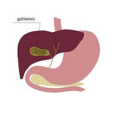 Gallstones, cholecystitis, images of the liver and gallbladder, stomach, pancreas. Vector illustration