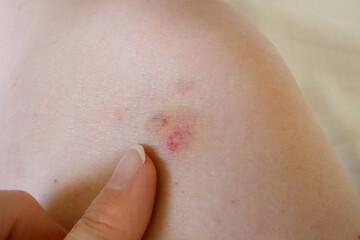 Fototapeta premium Allergic rash dermatitis leg skin, red allergy spots and skin inflammation on woman skin