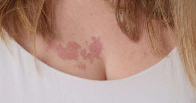 A Woman Showing Red Marks On The Upper Part Of Her Breast.  - Closeup Shot