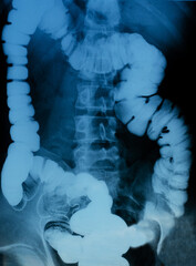 An X-ray of the intestine. The concept of diagnosis and treatment of diseases