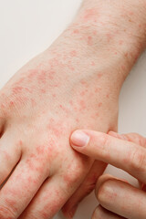 Hands with allergy reaction from taking medicines. By-effect, dermatology. Patient points on red...