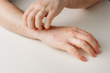 Male hands scratching itchy red spots on skin. Allergy reaction from wrong diet, by-effect from taking antibiotics or medicines. Skin disease