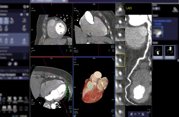 CTA Coronary artery  3D rendering image on the screen  for diagnosis of vessel coronary artery...