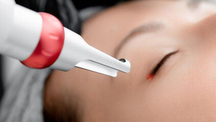 Laser removal of permanent make-up on face eyelashes of young woman in salon. Concept rejuvenation...