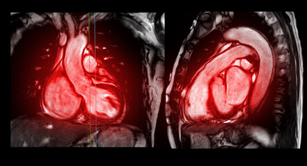 MRI heart or Cardiac MRI ( magnetic resonance imaging ) of heart compare RVOT and LVOT for diagnosis heart disease. - obrazy, fototapety, plakaty