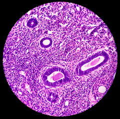 Cervix: Chronic cervicitis with prolapse, cervix show chronic inflammatory cells infiltration in...