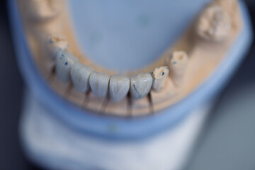 Dental prosthesis, dentures, prosthetics work. A study and a table with dental tools