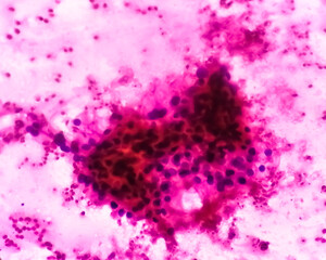 Kidney cancer: Microscopic image of clear cell carcinoma, the most common type of renal cell...