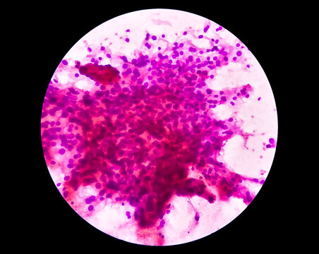 Kidney cancer: Microscopic image of clear cell carcinoma, the most common type of renal cell carcinoma. It is characterized by cytoplasmic clearing and a pattern of small branching blood vessels.