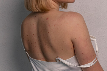 Young caucasian girl in a dress with pimples and acne, with red spots on her back, close-up