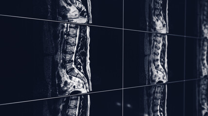 MRI Scan, Magnetic Resonance Images, of the spine
