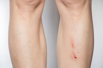 Female leg with a scratch after a fall on a white background, a wound on the leg