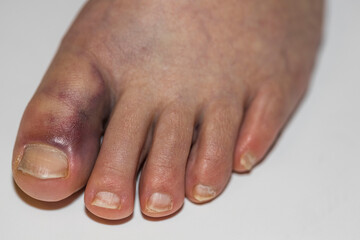 Close up view of damaged foot female with with bruise big toe. Injuries concept.