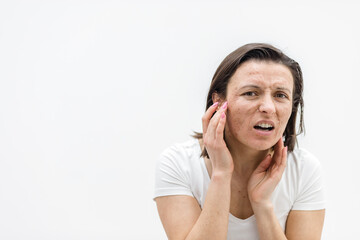 Naklejka premium Photo of woman having skin problems and feeling bad because of it.