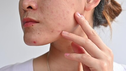 Close up of Asian woman having acne occur on her lower face. Conceptual shot of Acne and problem skin on female face.