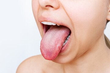 Cropped shot of a young woman showing tongue with a white plaque isolated on a white background....