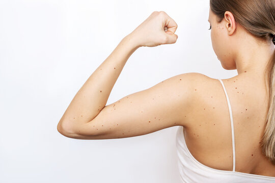 Rear view of a female back and arm with a large number of moles isolated on a white background. The effect of sunlight on the skin	