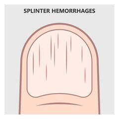 Acute aortic mitral valve bacteria fungi germs fever gum sepsis and Osler nodes insufficiency chest pain murmur sound palms hand skin rash nails eye with Roth spot
