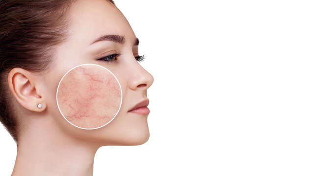 Young woman with couperose on face skin in zoom circle.