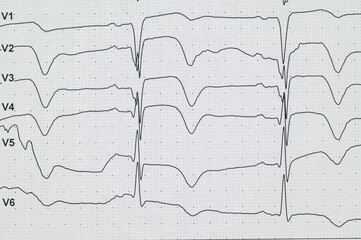 ECG. Myocardial infarctionon ECG. Angina.Chest pain. Close-up.