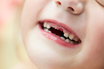 A little girl lost her baby milk tooth. Lost temporary tooth. The concept of oral hygiene in children. Close-up of the oral cavity