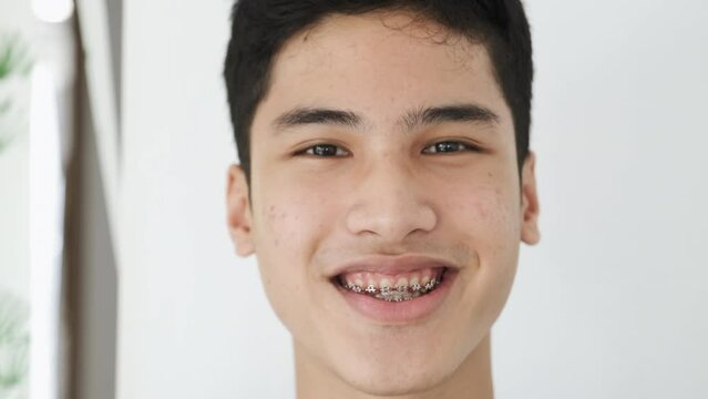Portrait of asian teenager smiling to camera, he wears dental braces brackets for teeth, having skin dermatological problems, acne. Concept of humans diversity, ethnic differences and individuality