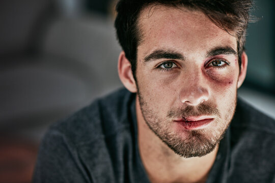 I may be beaten but I wont be broken. Cropped portrait of a beaten and bruised young man looking down.