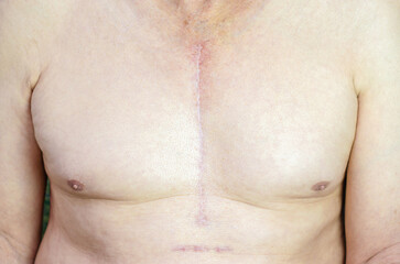 Shirtless Caucasian man with scar mark from CABG (Coronary Artery Bypass Graft) on his chest. Open...