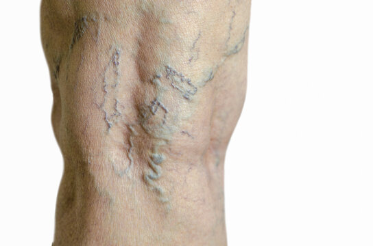 Older woman leg with varicose veins, deep vein thrombosis. Isolated on white background. Telangiectasias.