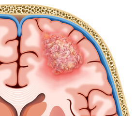 Ilustración descriptiva de un tumor cerebral, esta masa o bulto de células anormales afectará el funcionamiento del sistema nervioso.  - obrazy, fototapety, plakaty