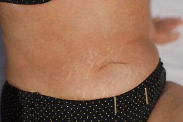 Woman with fat abdomen, overweight female stomach, stretch marks on belly closeup