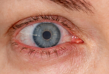 red inflamed eye with contact lens, close-up macrophoto. Dilation of blood vessels of eye, strain...