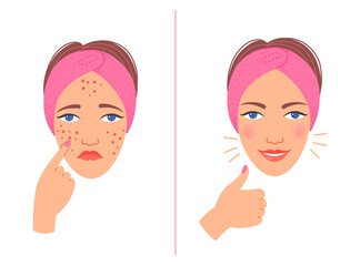 Acne treatment before after cartoon illustration. - 499827767