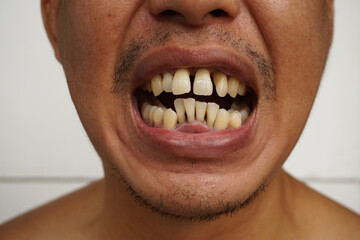Close up Bad teeth or crooked yellow teeth, Poor dental health, Must visit a dentist to install...
