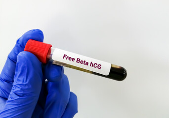 Fototapeta premium Blood sample for Free Beta hCG hormone test, health and medical concept