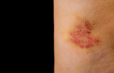 Bruises on the human body. Severe bruise from impact, bruising and hematoma.