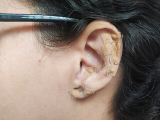 Auriculotherapy, or auricular therapy, or ear acupuncture, or auriculoacupuncture is a form of...