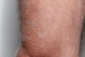 Fototapeta premium Large plaque parapsoriasis on caucasian man legs