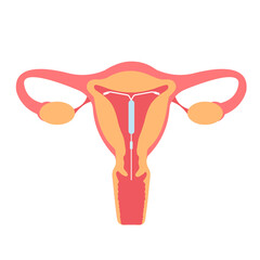 Intrauterine device IUD inside uterus. Female contraception, birth control, reproductive system, spiral. Sex education and responsibility concept
