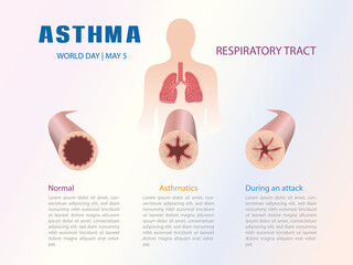 Infographic of the respiratory tract in an asthma process. - obrazy, fototapety, plakaty