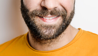 Lower part of beard man's face with herpes on his lips on white background