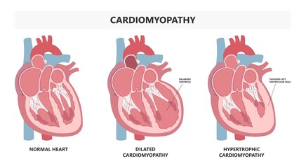 Cardiomyopathy Heart attack artery hypertrophy chamber stress stiff stretched high blood pressure valve right and left edema chest pain lupus immune system disorder arrest - obrazy, fototapety, plakaty