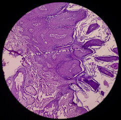 Micrograph of verrucae or chin skin wart, microscopic show epidermal hyperplasia with...