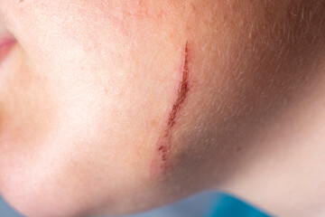 Wound on the chin close-up.