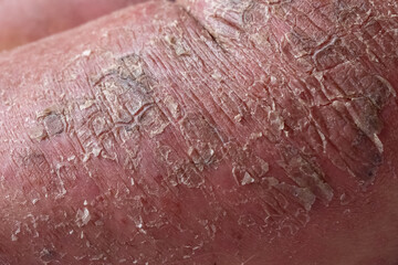 Fototapeta premium Closeup of cracked and dry skin disease. Medical healthcare concept. Cosmetology dermatology concept.