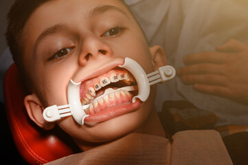 White retractor on lips and installation of metal braces on teen's upper teeth.