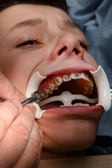 The teenager has braces glued to his upper teeth to straighten them, and the boy has a retractor on his lips.