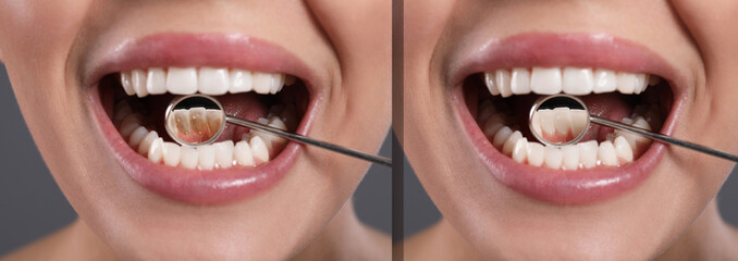 Collage with photos of woman before and after professional treatment of dental plaque, closeup. Banner design - obrazy, fototapety, plakaty